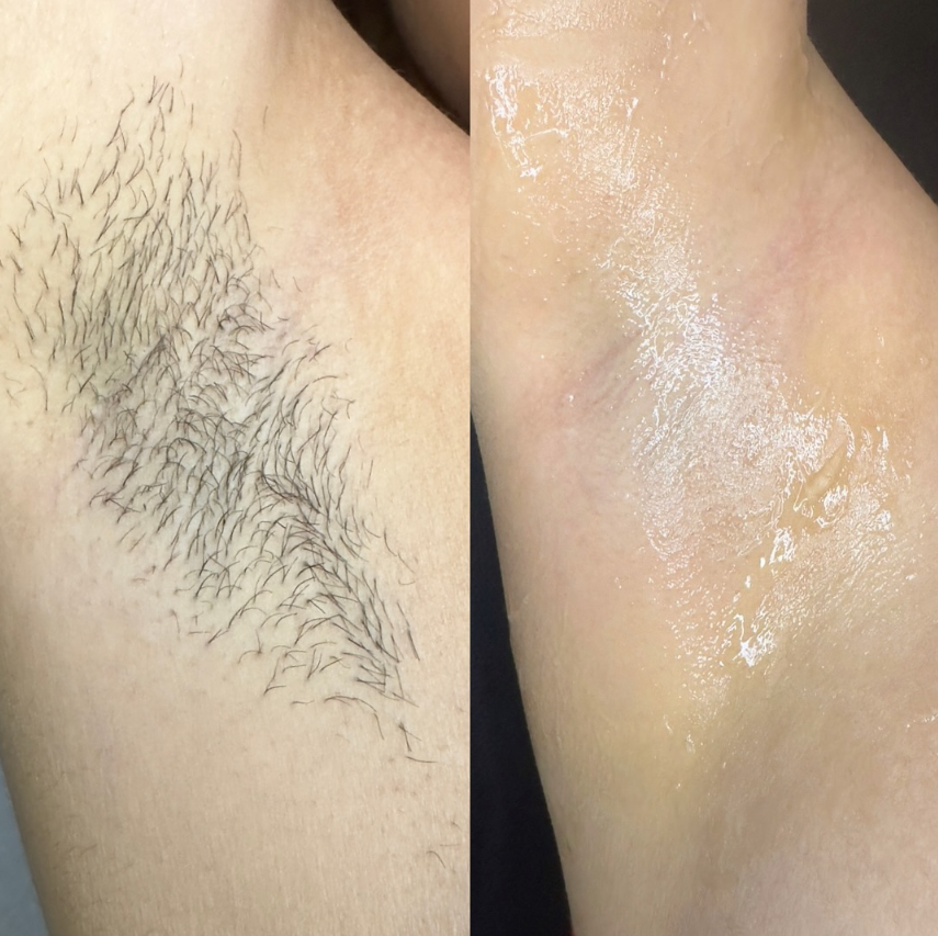 Underarm hair removal results
