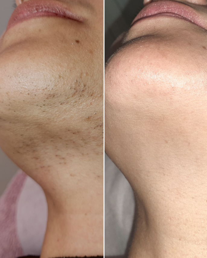 hair removal results