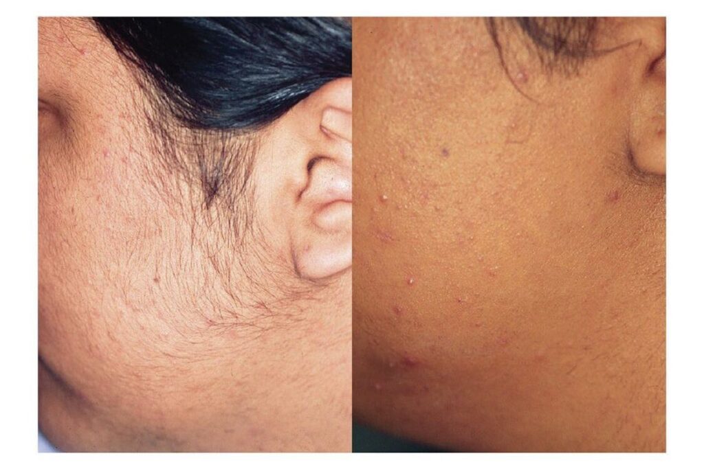 hair removal results